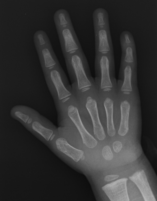 normal child wrist x ray