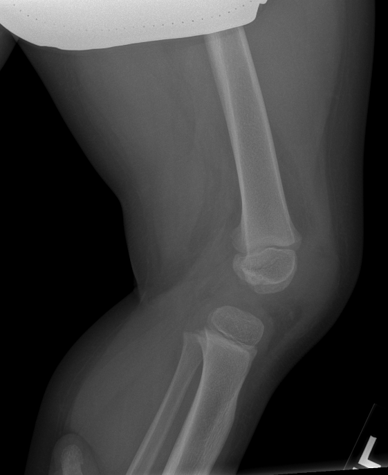Normal Knee Xray - Normal Knee X Rays Radiology Case Radiopaedia Org.